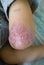 Psoriasis on kid\'s elbow