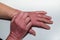 A psoriasis patient scratches his hands. Itching of the skin with chronic dermatoses - psoriasis, eczema, dermatitis