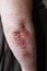 Psoriasis skin. Psoriasis is an autoimmune disease that affects the skin cause skin inflammation red and scaly. Eczema