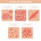 Psoriasis types. Skin problems close up medical illustrations vector set