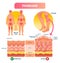 Psoriasis vector illustration. Skin disease and illness. Labeled structure.