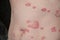 Psoriasis Vulgaris, skin patches are typically red, itchy, and scaly.