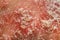 Psoriasis Vulgaris. Skin of a psoriasis patient close-up. Macro, shallow depth of field