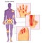 Psoriatic arthritis illustration