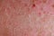 Psoriatic eczema is a skin condition that falls under realm of dermatology.