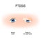 Ptosis is a drooping of the upper eyelid. lazy eye