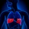 Pulmonary Edema - Blood in Lungs