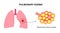 Pulmonary edema disease