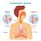 Pulmonary edema - respiratory lung disease infographic with flat cartoon man drawing showing his internal organs