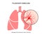 Pulmonary embolism disease