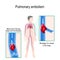 Pulmonary embolism. Human silhouette with highlighted circulatory system.