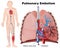 Pulmonary  embolism medical  illustration with description on white background