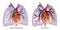 Pulmonary hypertension