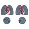 Pulmonary hypertension.