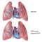 Pulmonary hypertension