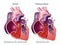 Pulmonary stenosis