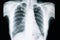 pulmonary tuberculosis