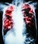 Pulmonary Tuberculosis