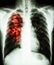 Pulmonary tuberculosis