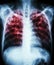 Pulmonary tuberculosis