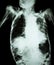 Pulmonary Tuberculosis with acute respiratory failure ( Film chest x-ray of old patient show alveolar and interstitial infiltratio