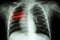 Pulmonary Tuberculosis ( Chest X-ray of child : show patchy infiltration at right middle lung )