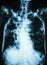 Pulmonary Tuberculosis . film chest x-ray of old patient show interstitial infiltration both lung and calcification at trachea c