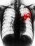 Pulmonary Tuberculosis . Film chest x-ray show alveolar infiltrate at left middle lung due to Mycobacterium tuberculosis infection