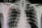 pulmonary tuberculosis in the right upper lung