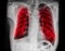 Pulmonary Tuberculosis TB : Chest x-ray show alveolar infiltration at both lung