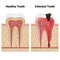 Pulpitis and Healthy tooth