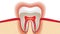 Pulsation of sensitive tooth enamel