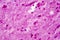 Purulent meningitis, light micrograph
