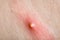 Purulent pimple on inflamed human skin.