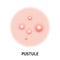 Pustule skin acne type vector icon. Skin disease acne pustules pimples type, face pore comedones