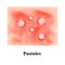 Pustules on the skin. Acne. Pimples on the skin. Infographics. Vector illustration.