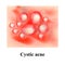 Pustules on the skin. Cystic acne. Pimples on the skin. Infographics. Vector illustration.