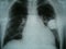 Radiograph, chest, heart pacemaker