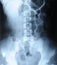 Radiograph of human backbone