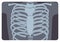 Radiograph, X-radiation picture or X-ray image of rib or thoracic cage formed by vertebral column and sternum. Medical