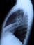 Radiography of chest