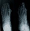 Radiography of foot