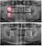 Radiography images before and after the removal of three wisdom teeth