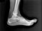 Radiography of a operated foot, after trauma