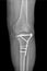 Radiography of the operated Tibia, in a patient after an accident