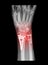 Radius fracture on x-ray