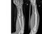 Radius Ulna Radiograph showing Fractures