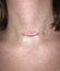 Raised hypertrophic scar on neck after thyroidectomy