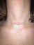 Raised hypertrophic scar on neck after thyroidectomy