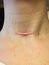 Raised hypertrophic scar on neck after thyroidectomy